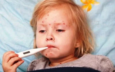 Cacar Air Pada Anak Dan Balita Serta Pengobatannya