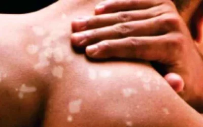 Cara Mengobati Panu dan Mencegah Agar Tidak Kambuh