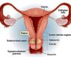 Kanker Rahim – Mengenal Penyebab, Ciri dan Cara Mengatasi