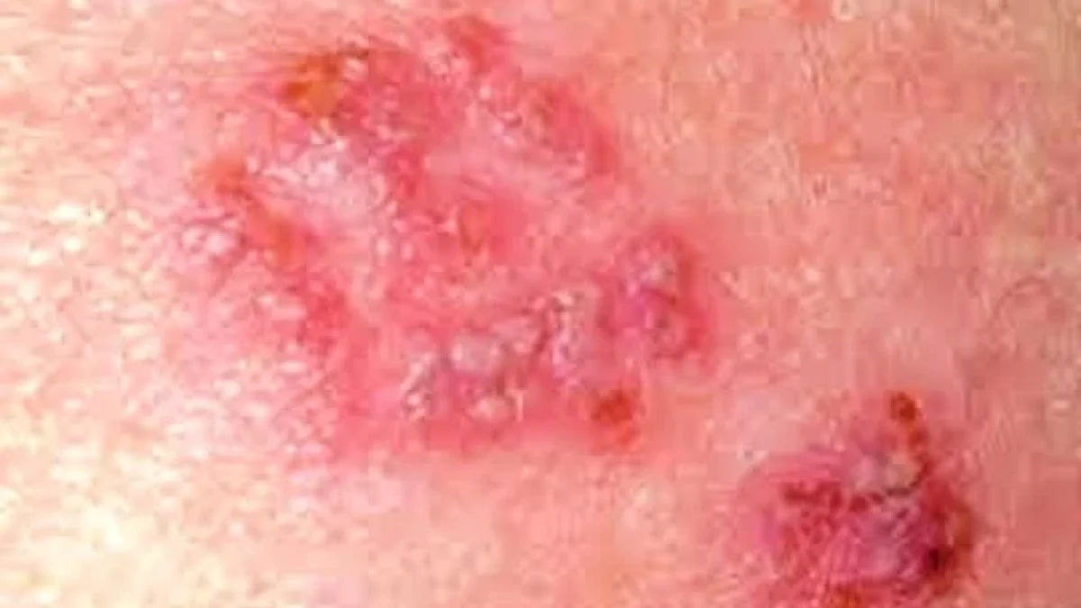 Penyakit Pada Kulit Dompo atau Herpes dan cara Pengobatannya