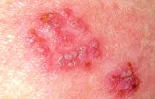 Penyakit Pada Kulit Dompo atau Herpes dan cara Pengobatannya