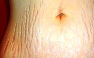 Tips Jitu Menghilangkan Stretch Mark Di Perut dan Paha