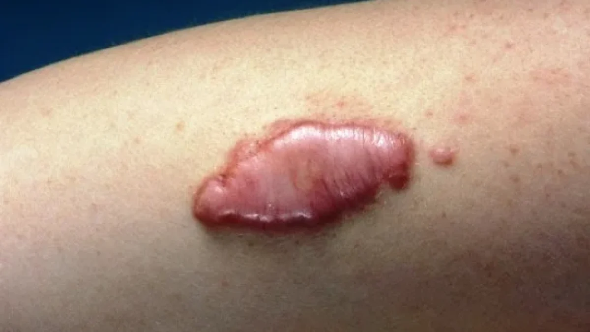 Cara Ampuh Menghilangkan Keloid