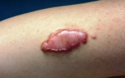 Cara Ampuh Menghilangkan Keloid