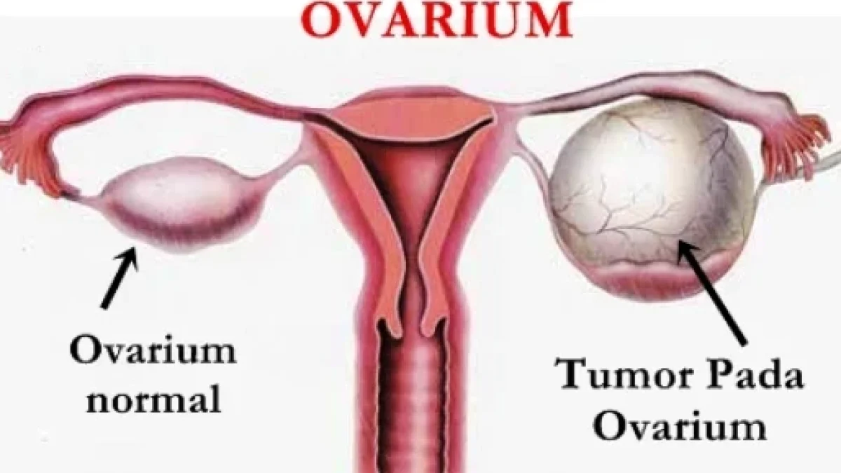 Waspada Kanker Ovarium, Gejala dan Faktor Resiko