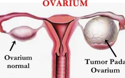 Waspada Kanker Ovarium, Gejala dan Faktor Resiko