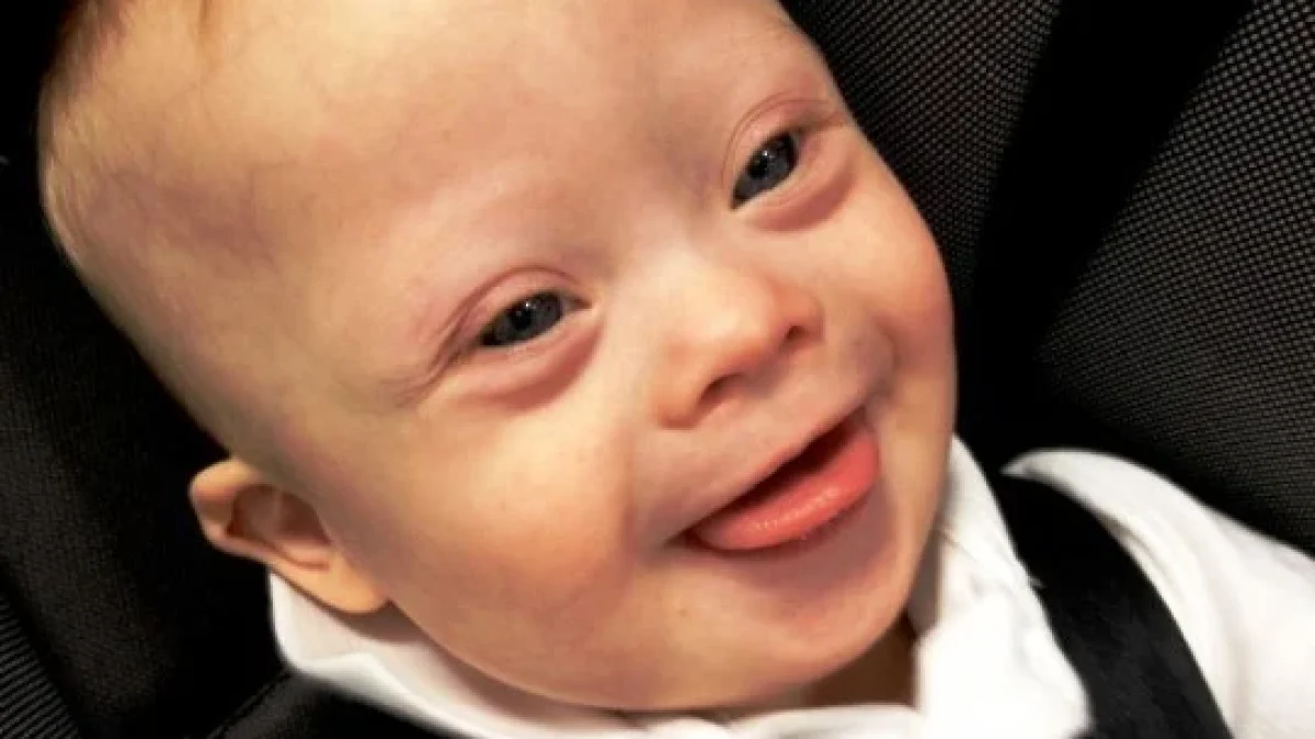Edwards Syndrome: Pengertian Dan Ciri Fisik