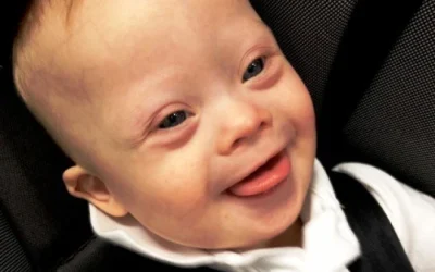 Edwards Syndrome: Pengertian Dan Ciri Fisik