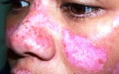 Mengenal Gejala Awal Penyakit Lupus