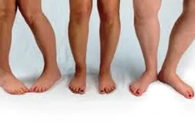 Kaki Bengkok: Jenis Dan Tanda Kelainan