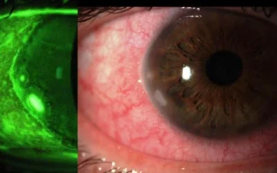 Cara Mengobati Keratitis Pada Mata Serta Penyebab Hingga Gejalanya