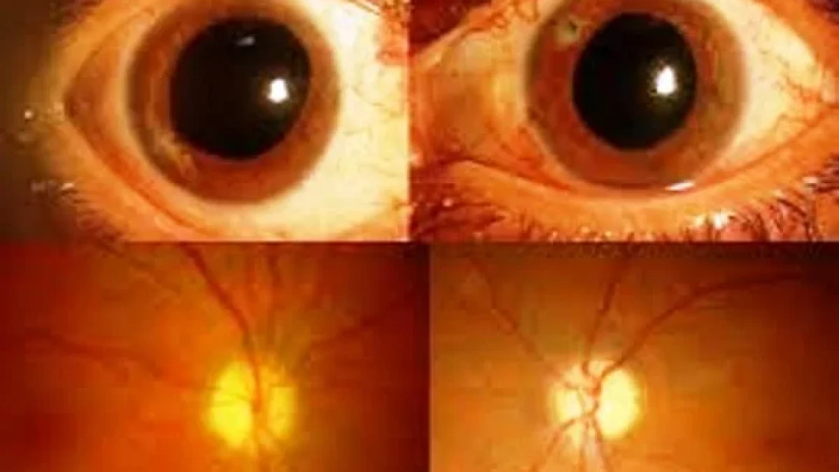 Neuritis Optik. Gejala, Penyebab, Diagnosa, Penyembuhan