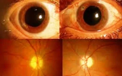 Neuritis Optik. Gejala, Penyebab, Diagnosa, Penyembuhan