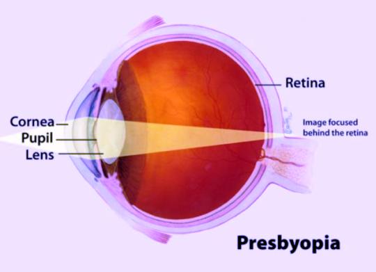 presbiopi gejala penyebab cara mengatasi