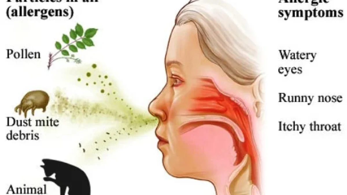 Rhinitis: Gejala, Penyebab, Pengobatan
