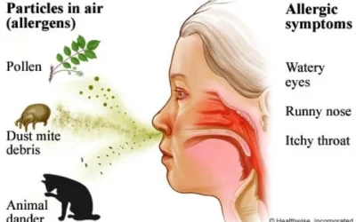 Rhinitis: Gejala, Penyebab, Pengobatan