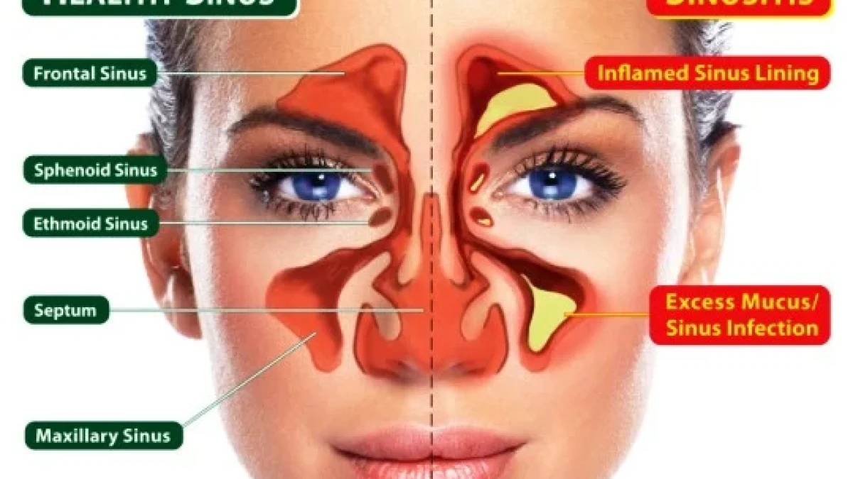 Sinusitis: Gejala, Penyebab, Cara Mengatasi