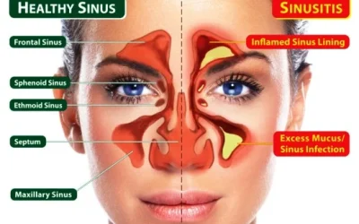 Sinusitis: Gejala, Penyebab, Cara Mengatasi