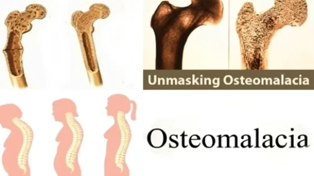 Tulang Rapuh (Osteomalasia): Definisi, Gejala, Penyebab, Pengobatan