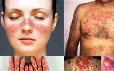 Mengenal Penyakit Lupus, Penyakit Seribu Wajah.
