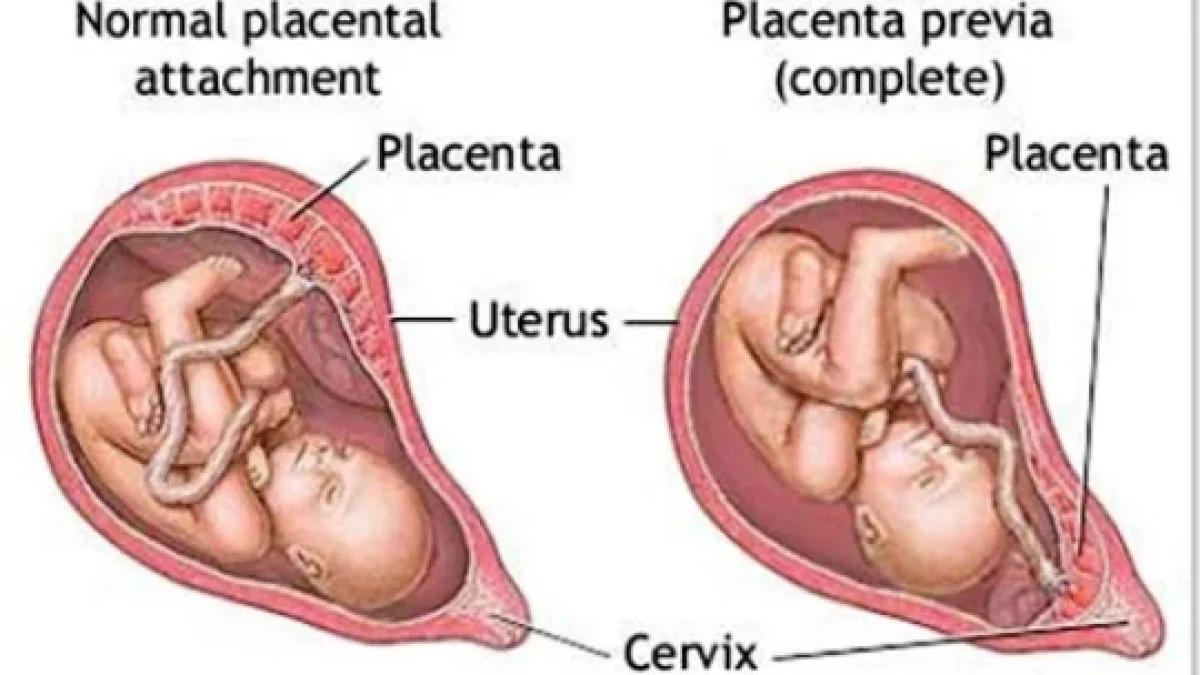 Placenta Previa. Tipe, Gejala, Penyebab, Perawatan
