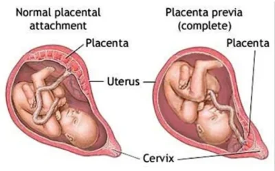Placenta Previa. Tipe, Gejala, Penyebab, Perawatan