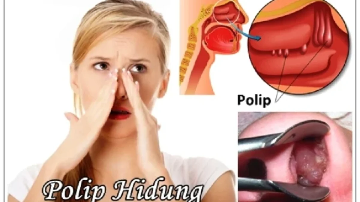 Polip Hidung: Penyebab, Gejala, Pengobatan