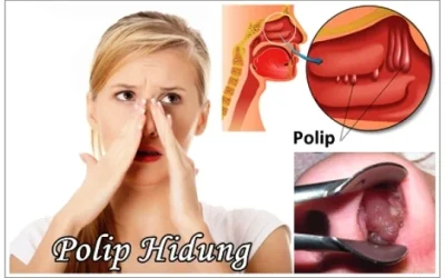 Polip Hidung: Penyebab, Gejala, Pengobatan