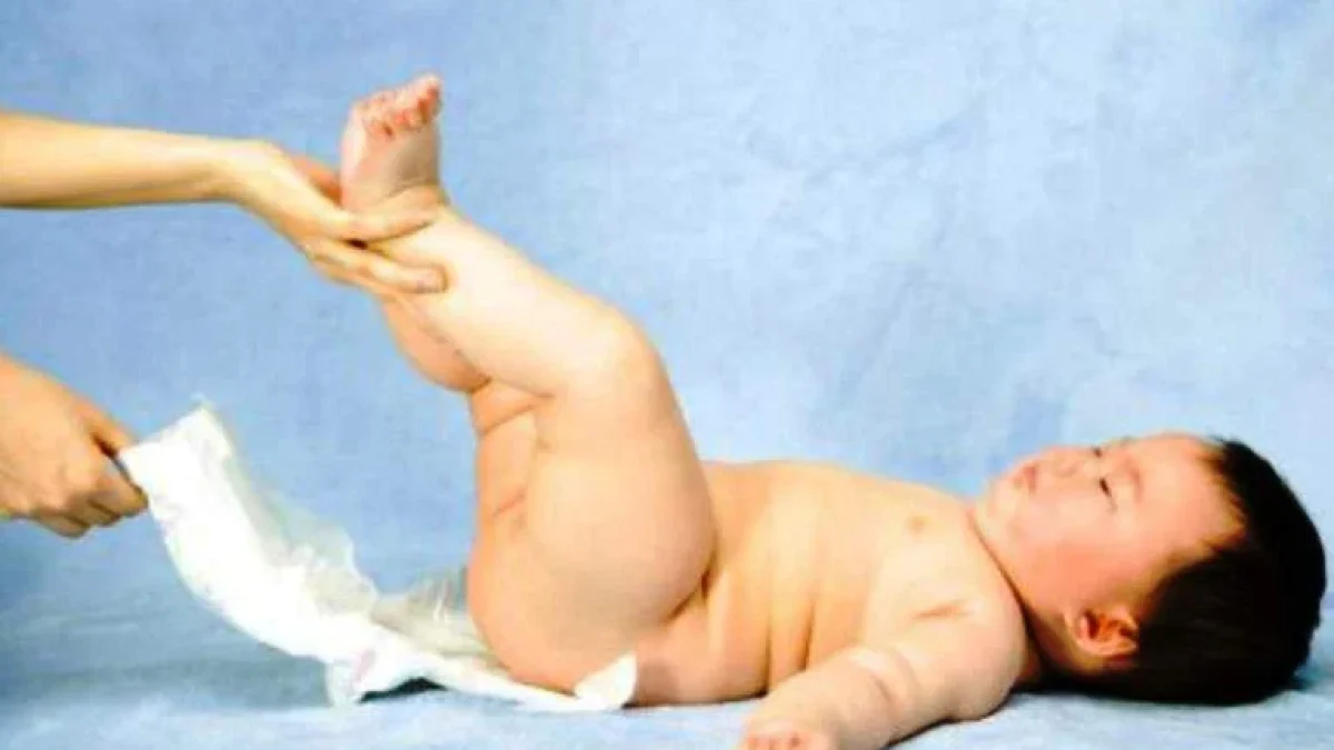 Cradle Cap Serta Lecet Pada Bayi dan Cara Mengatasinya