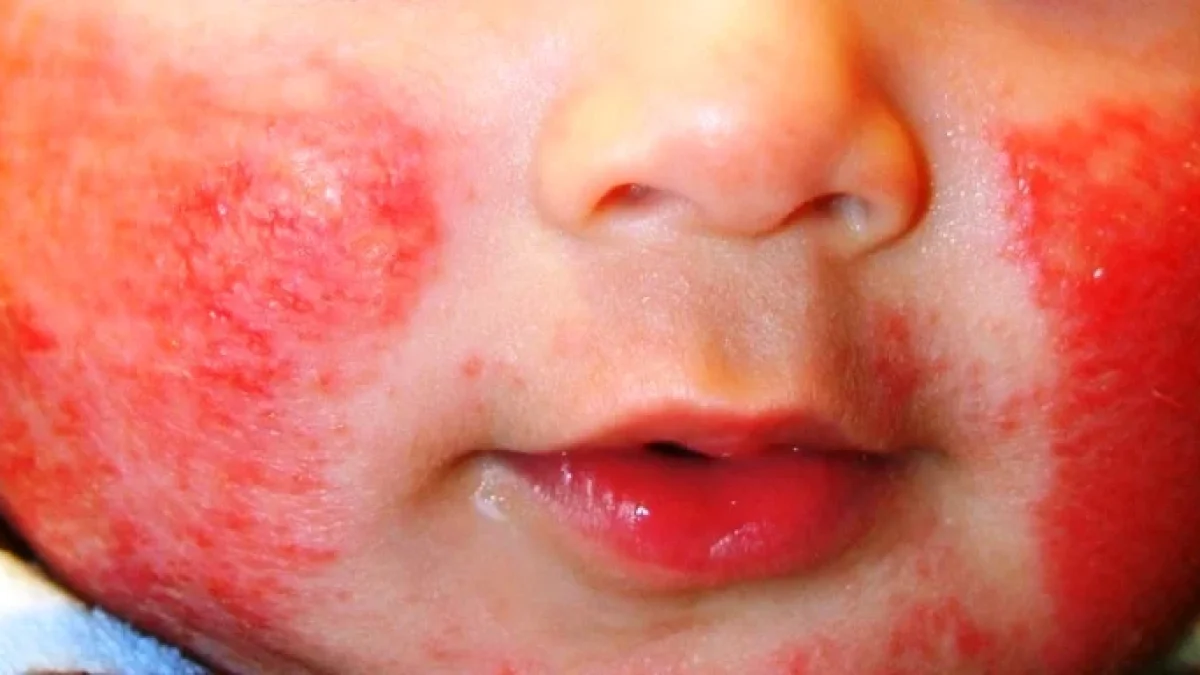 Cara Mengobati dan Mencegah Dermatitis Atopik (Eksim)