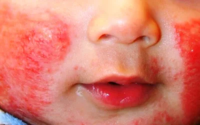 Cara Mengobati dan Mencegah Dermatitis Atopik (Eksim)