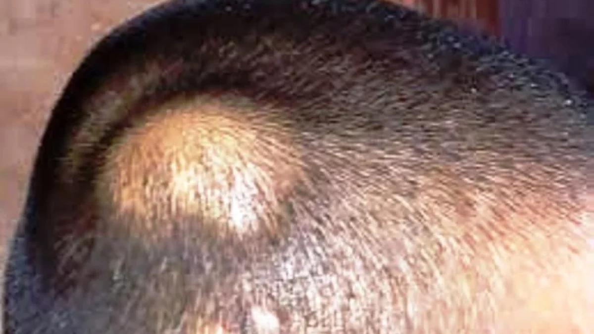 Lipoma Pada Anak, BERBAHAYAKAH ???