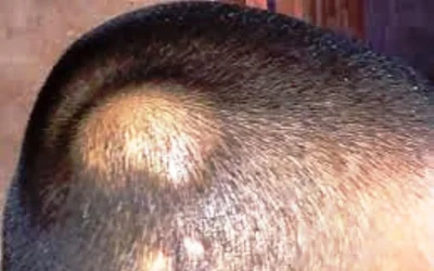 Lipoma Pada Anak, BERBAHAYAKAH ???