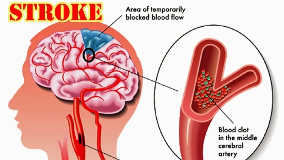 Cara Pemeriksaan dan Pencegahan Penyakit Stroke