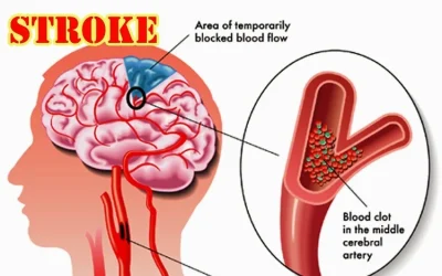 Cara Pemeriksaan dan Pencegahan Penyakit Stroke