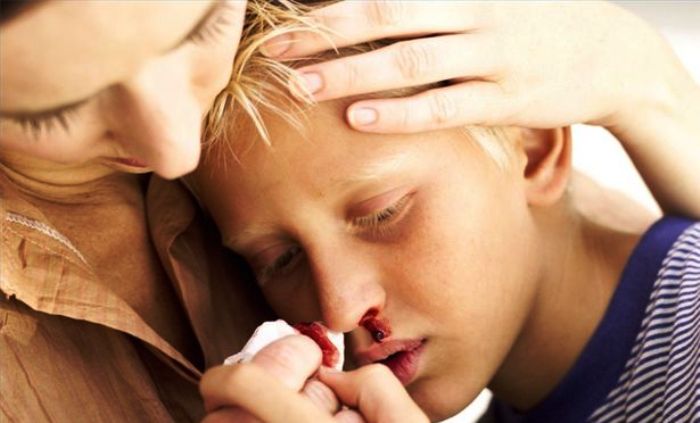 penyebab dan gejala mimisan pada anak