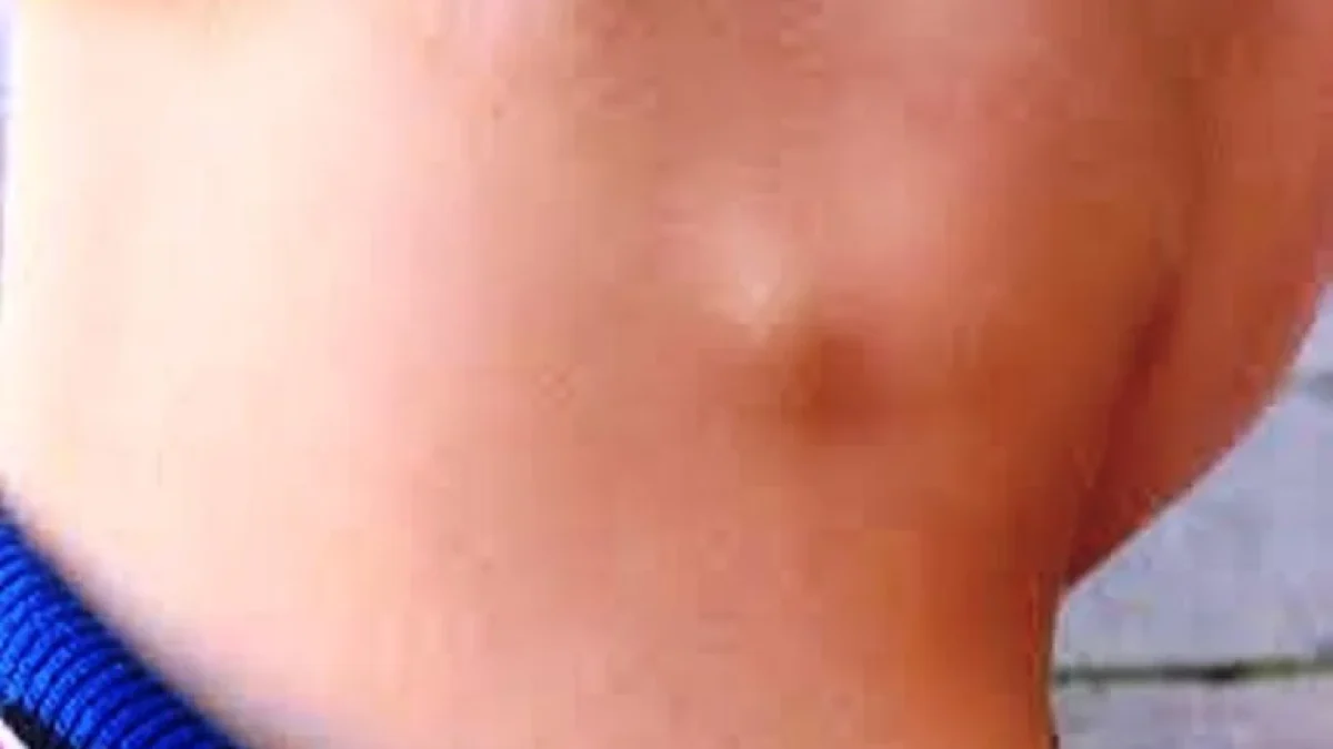 Penyebab Pembengkakan Kelenjar Getah Bening Dan Pengobatannya