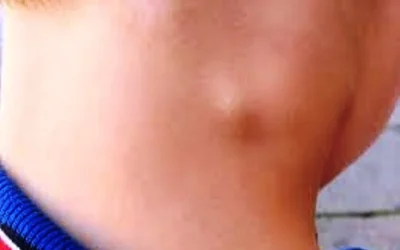 Penyebab Pembengkakan Kelenjar Getah Bening Dan Pengobatannya