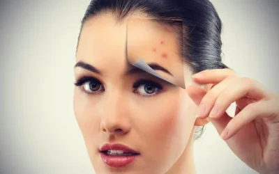 8 Cara Ampuh Menghilangkan Jerawat Batu Dengan Bahan Alami