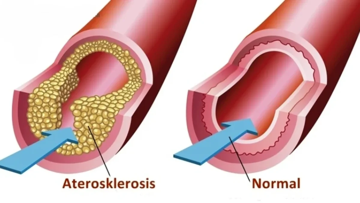Tips Membersihkan Arteri Yang Tersumbat Secara Alami