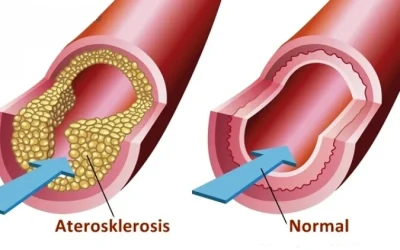 Tips Membersihkan Arteri Yang Tersumbat Secara Alami