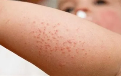 Cara Ampuh Mengatasi Biang Keringat Pada Bayi