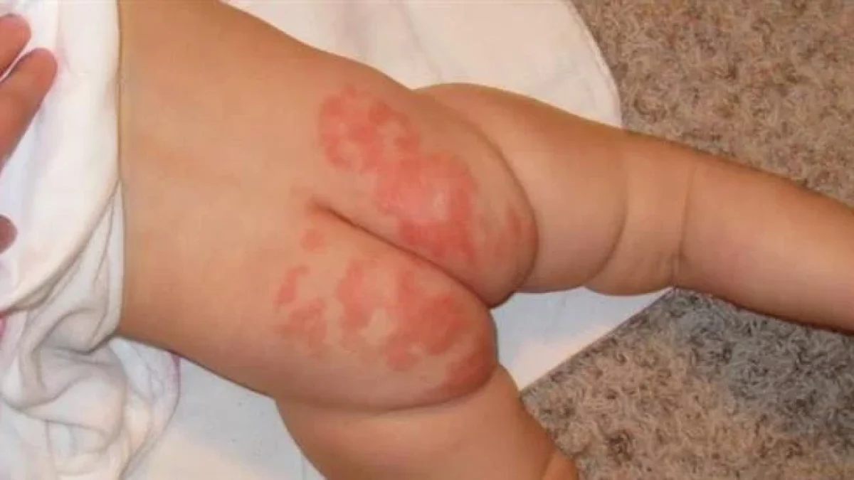 Cara Cepat Mengatasi Ruam Popok Pada Bayi