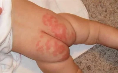 Cara Cepat Mengatasi Ruam Popok Pada Bayi