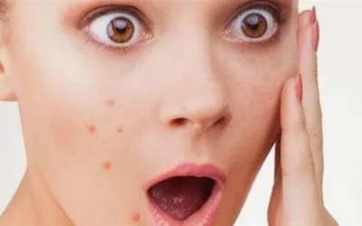 Cara Menghilangkan Flek Hitam Dengan Lemon