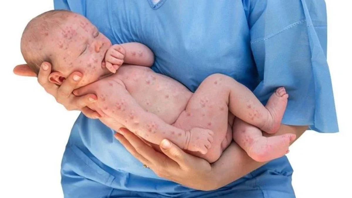 Cegah Penyakit Rubella Dengan Imunisasi MMR