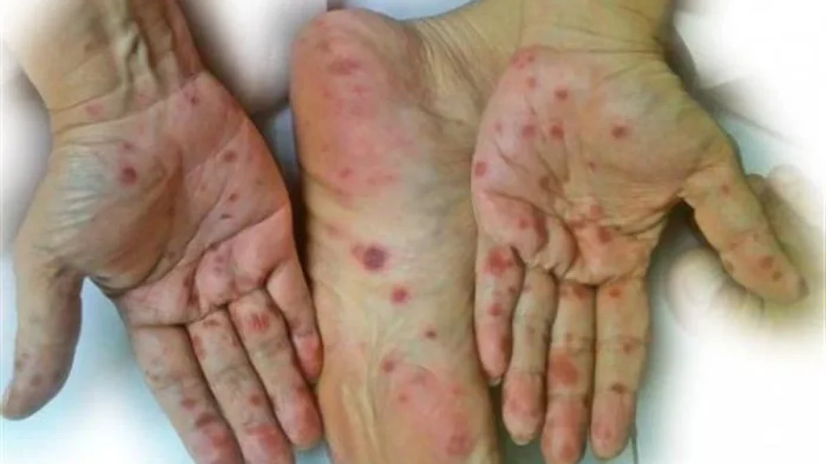 Flu Singapura Rentan Menyerang Anak Kenali Gejalanya Sejak Awal