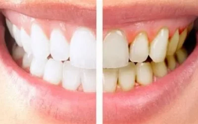 Cara Cepat Membersihkan Karang Gigi Secara Alami