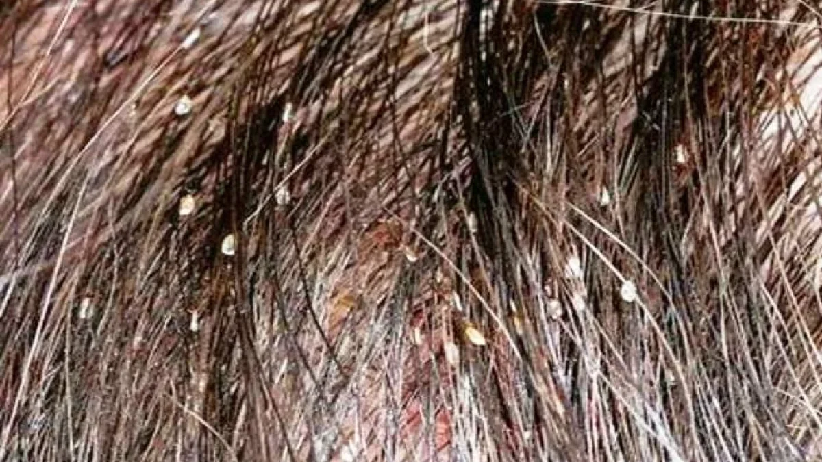 Cara Menghilangkan Kutu Rambut dan Telurnya Mudah Cepat dengan Cepat 1 Hari
