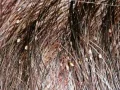 Cara Menghilangkan Kutu Rambut dan Telurnya Mudah Cepat dengan Cepat 1 Hari